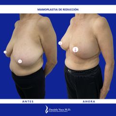 Mamoplastia de reducción - Dra. Daniela Stephania Vaca Grisales