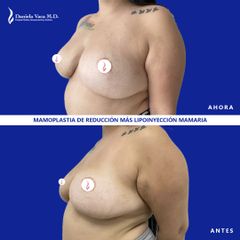 Mamoplastia de reducción - Dra. Daniela Stephania Vaca Grisales