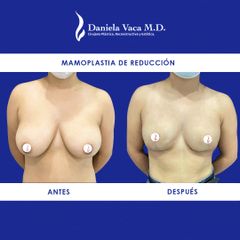 Mamoplastia de reducción - Dra. Daniela Stephania Vaca Grisales