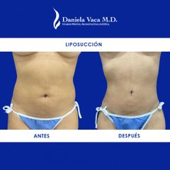 Liposucción - Dra. Daniela Stephania Vaca Grisales