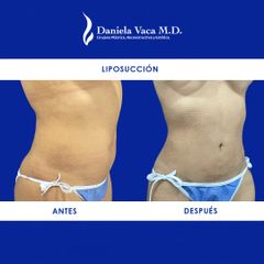 Liposucción - Dra. Daniela Stephania Vaca Grisales