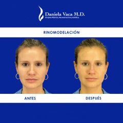 Rinomodelación - Dra. Daniela Stephania Vaca Grisales