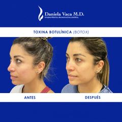 Toxina Botulínica - Dra. Daniela Stephania Vaca Grisales