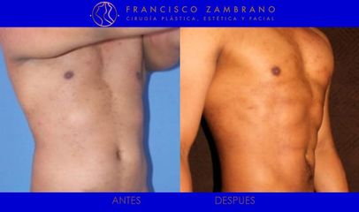 Marcación abdominal en hombre
