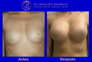 Mamoplastia de aumento con Volumen del implante 350 cc lisos