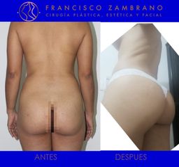Lipoinyección glútea - Dr. Francisco Zambrano