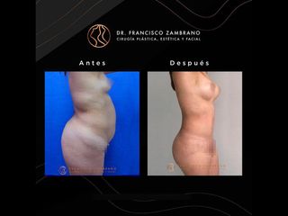 Liposucción - Dr. Francisco Zambrano