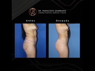 Liposucción - Dr. Francisco Zambrano