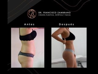 Liposucción - Dr. Francisco Zambrano