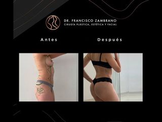 Liposucción - Dr. Francisco Zambrano