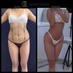 Liposucción - Dr. Francisco Zambrano