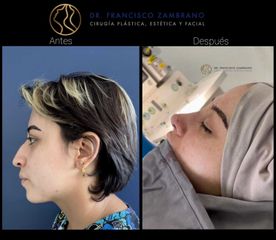Rinoplastia - Dr. Francisco Zambrano