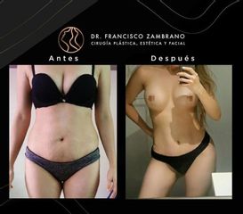 Liposucción - Dr. Francisco Zambrano