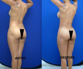 Gluteoplastia - American Plastic