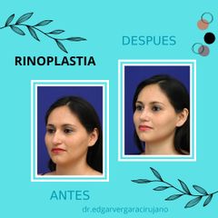 rinoplastia - Dr. Edgar Ismael Vergara y Dra. Judith Cadavid