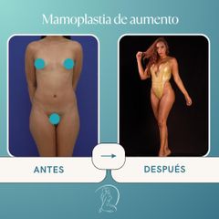 mamoplastia de aumento - Dr. Edgar Ismael Vergara y Dra. Judith Cadavid