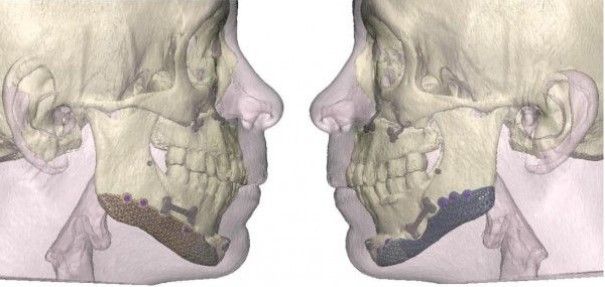 Exemple d'implants mandibulaires