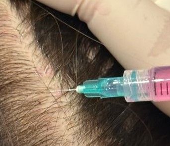 Injections dans le cuir chevelu