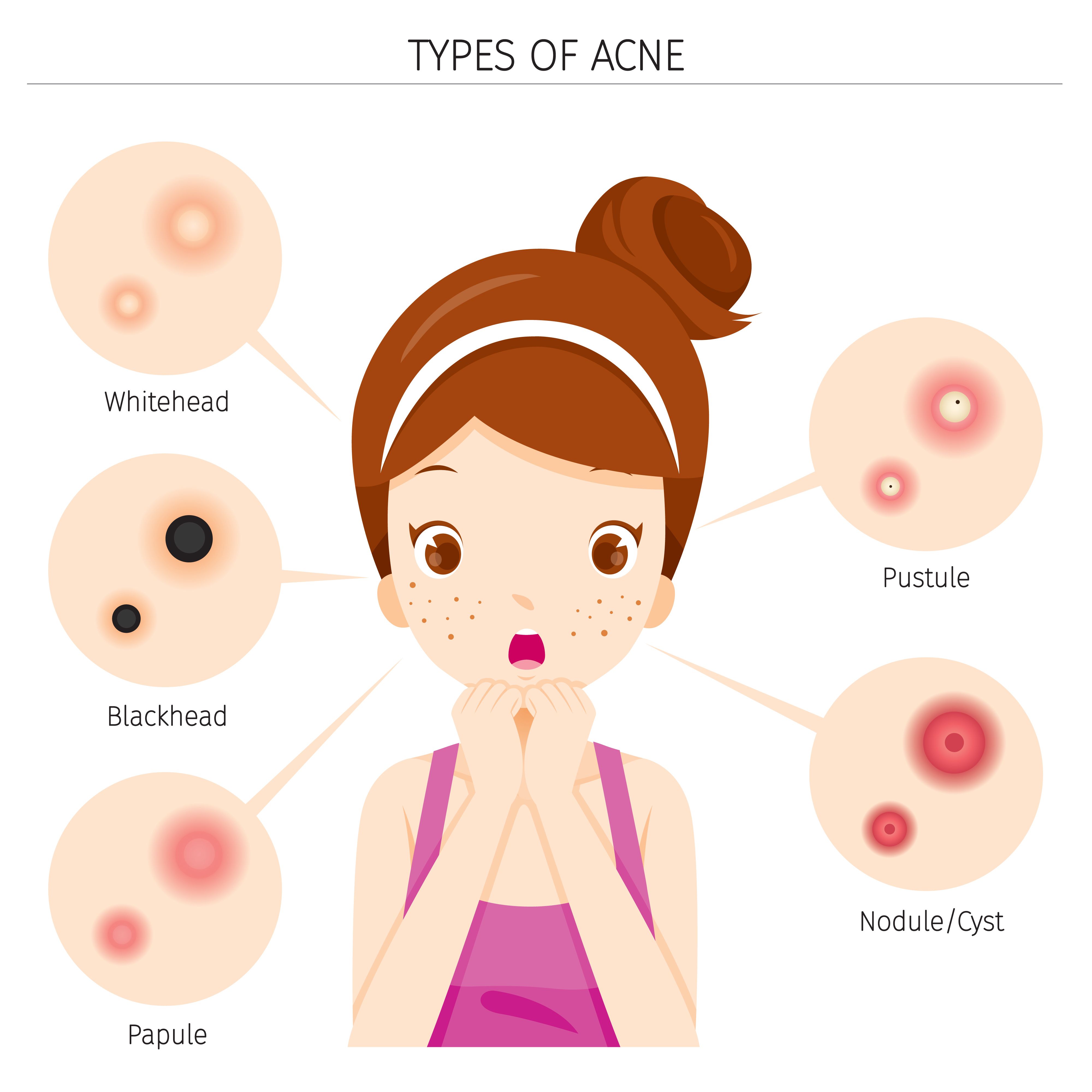 les différentes formes d'acné