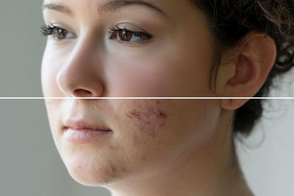 Il existe différents types de cicatrices d'acné qui peuvent présenter différents aspects