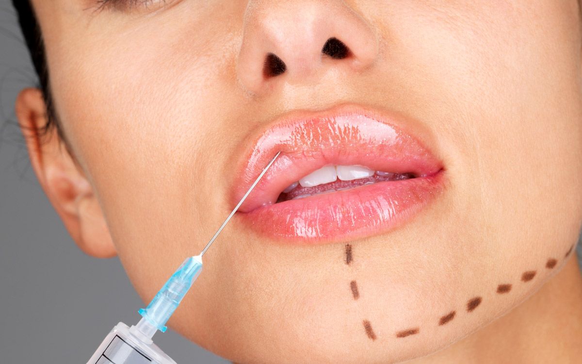 Injection acide hyaluronique des lèvres