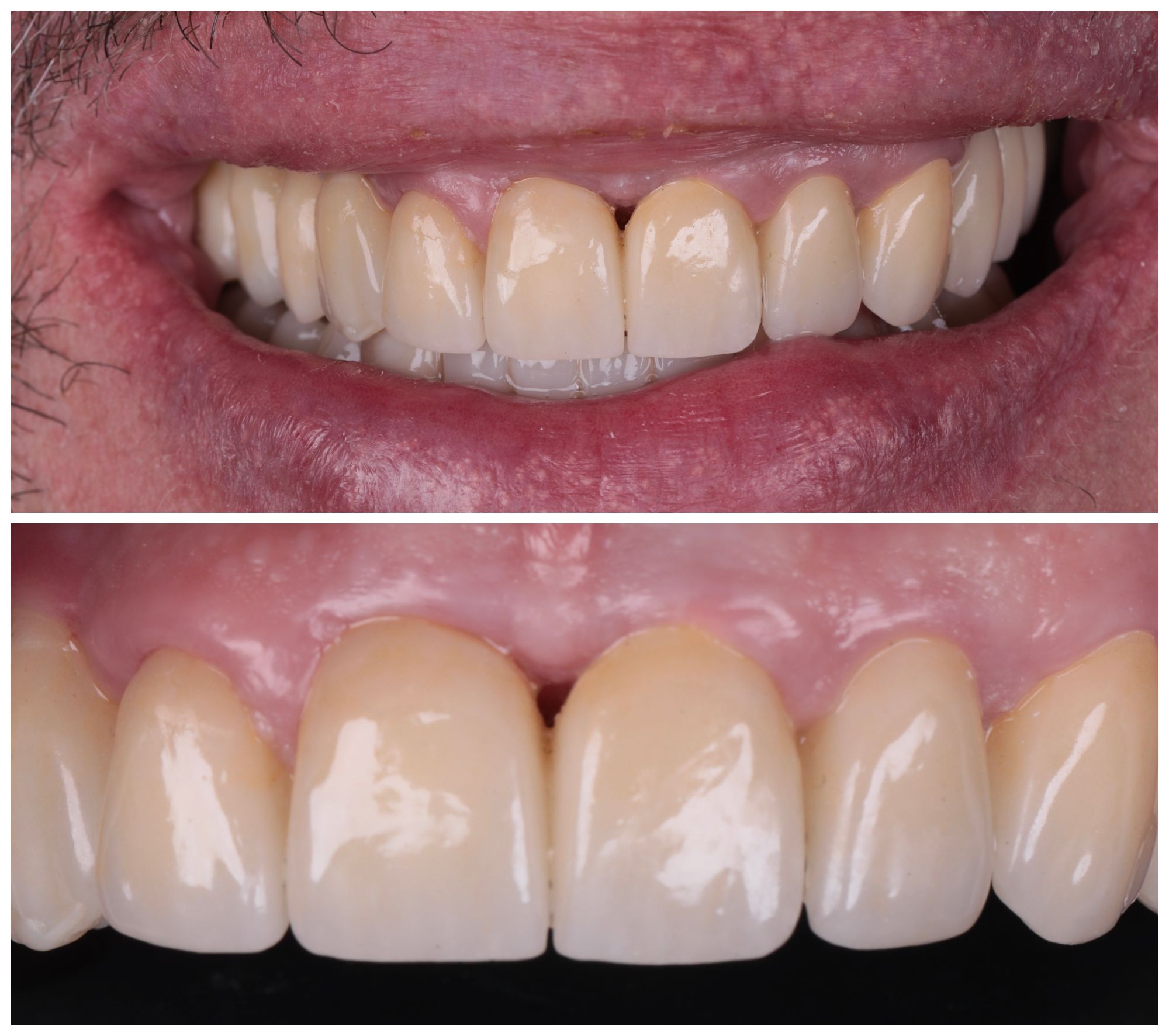 Réhabilitation dentaire complête par le Dr Ramzi Redissi