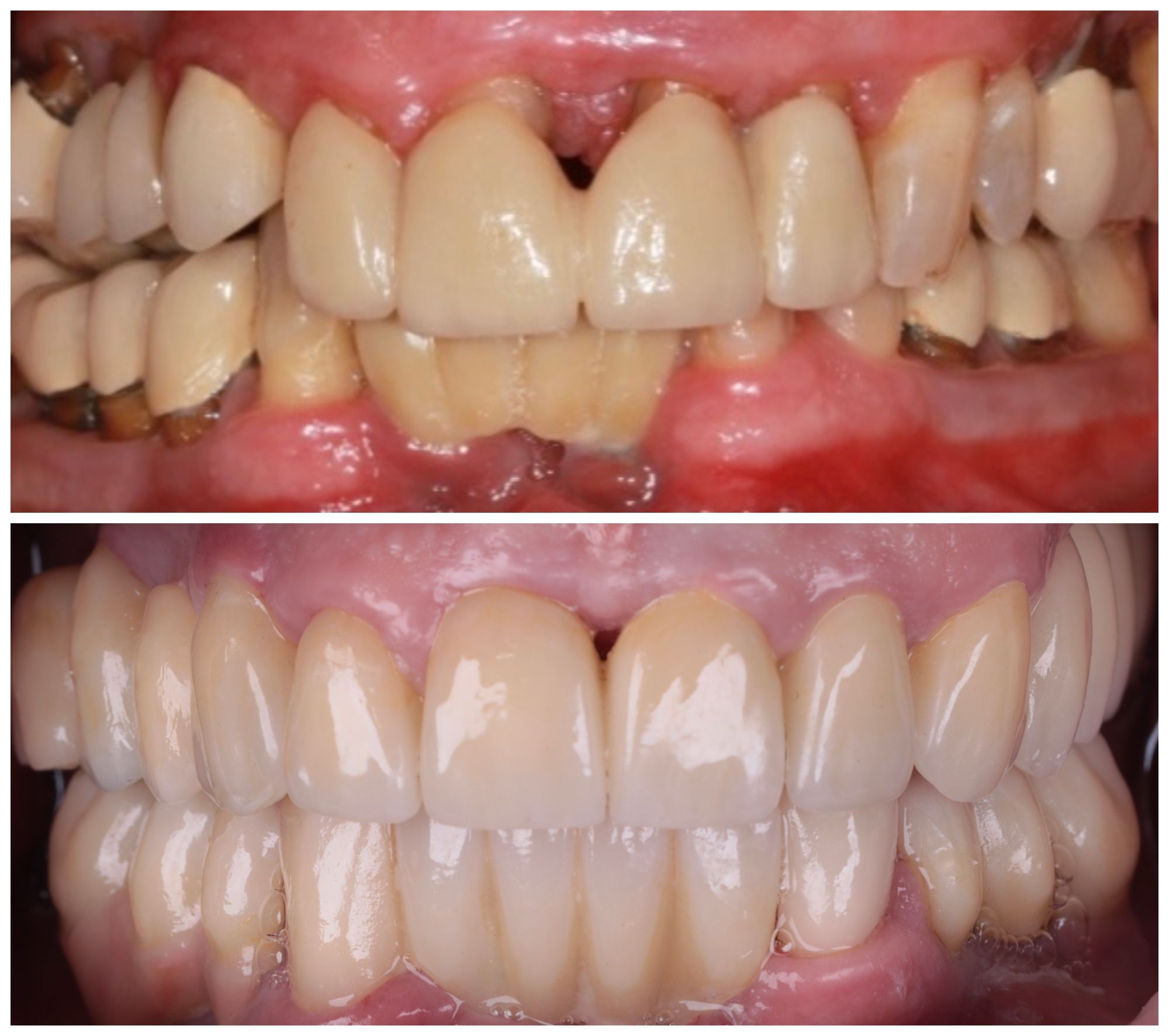 Avant après Réhabilitation dentaire complête par le Dr Ramzi Redissi