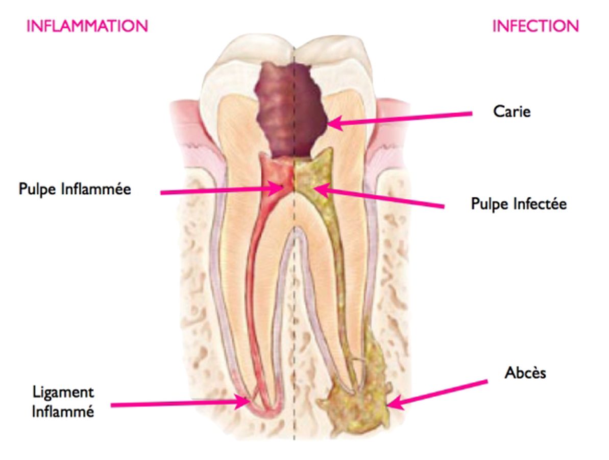 Dent nécrosée schéma
