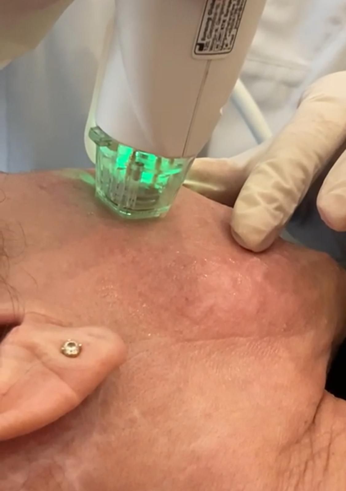 Radiofréquence microneedlée