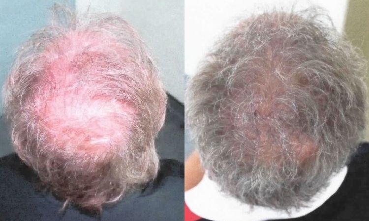 Avant et Après Méthode Macro Greffe De Cheveux