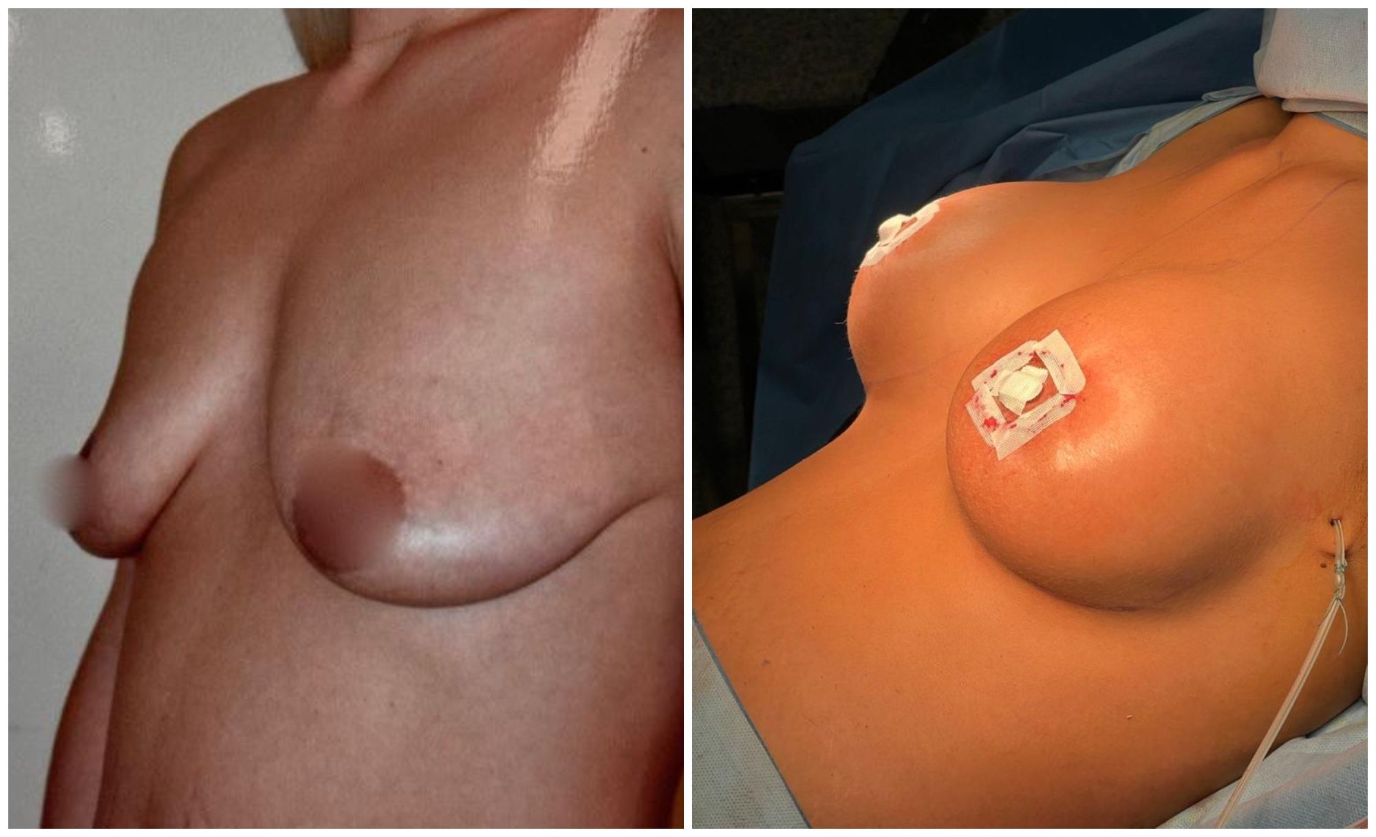 Photo avant/après d´une augmentation mammaire - voie d'abord péri-aréolaire