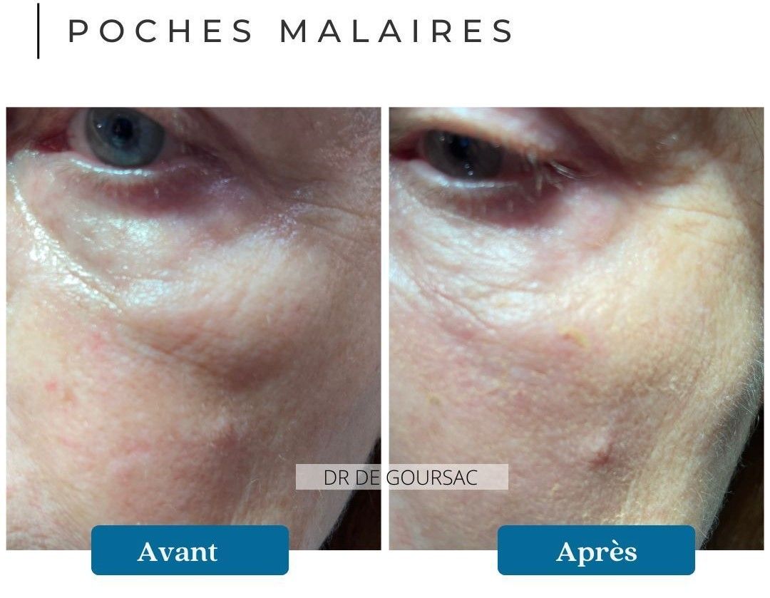 poches malaires