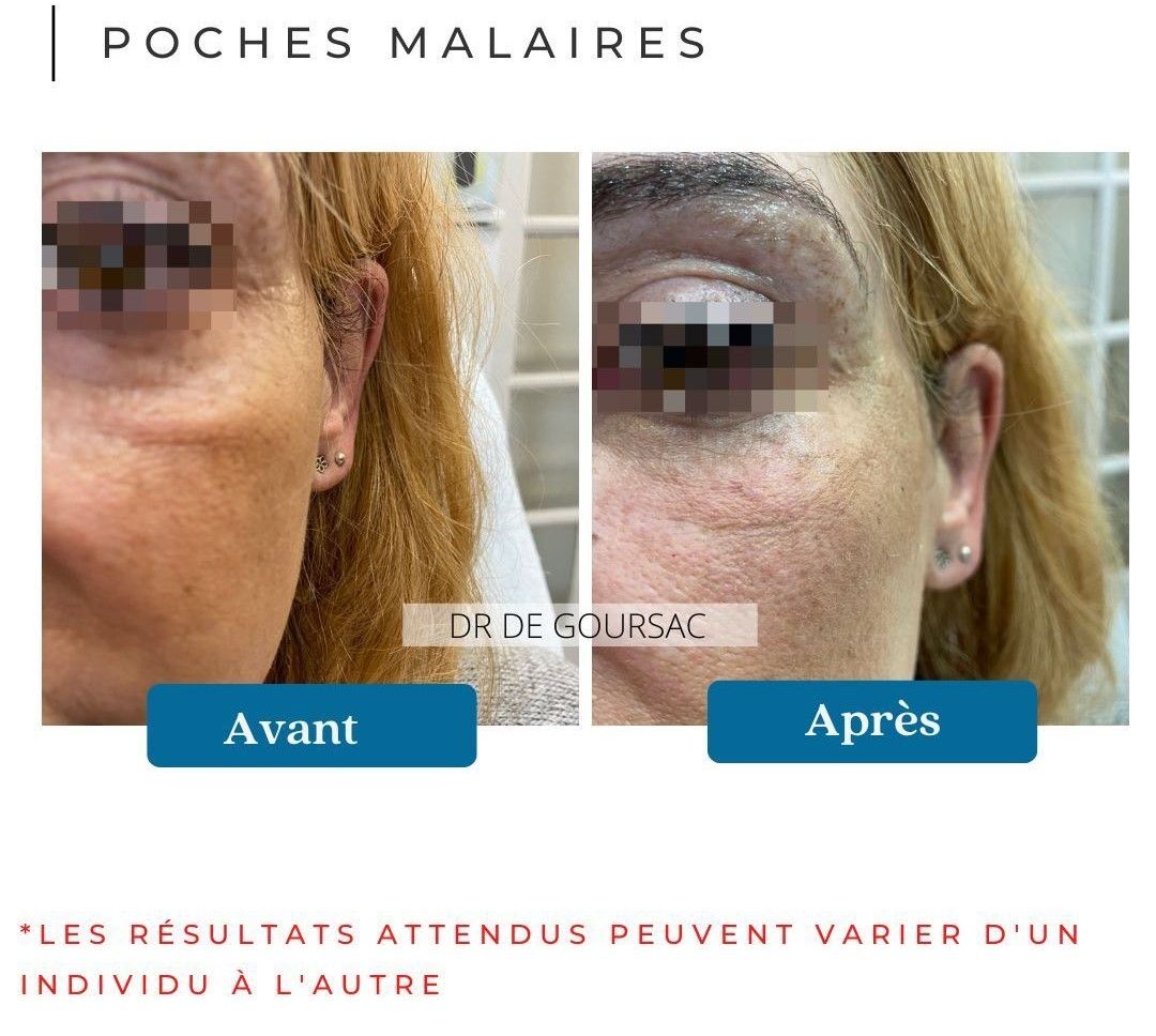 Poches malaires