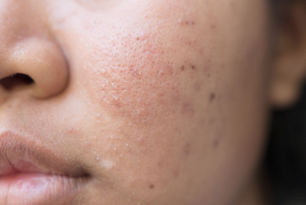 traitement anti-acné