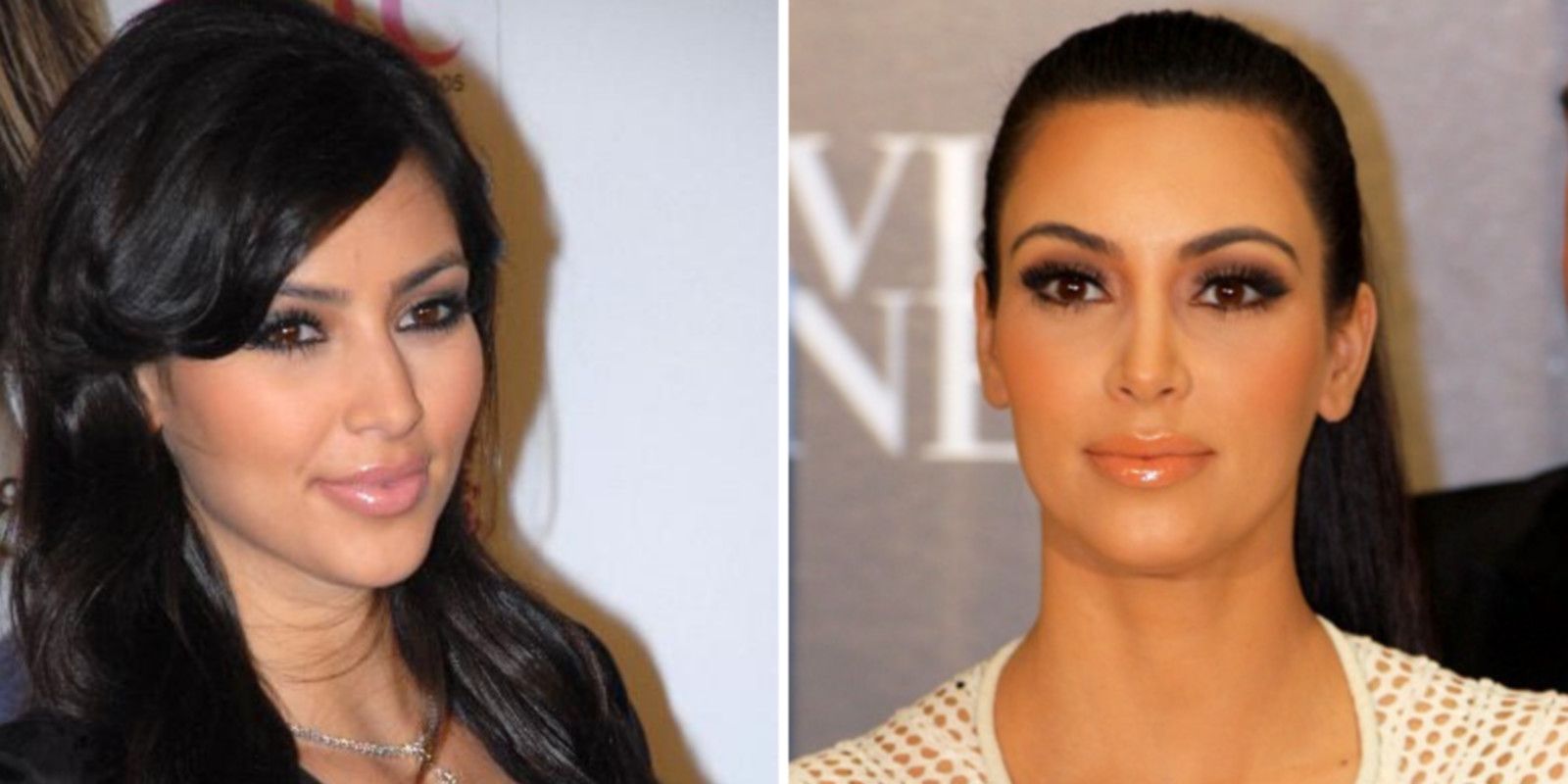 Kim Kardashian bichectomie avant / après