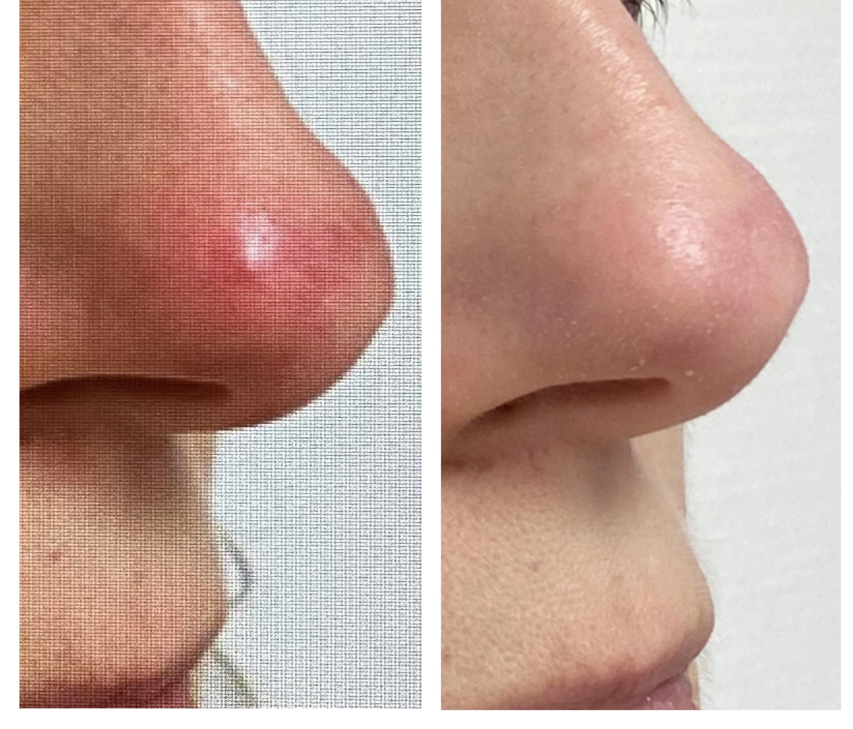 Traitement de l'erythrose du nez après une seance de laser ICON MAX G