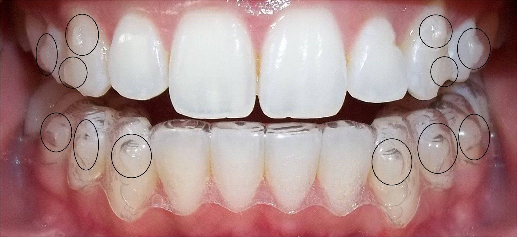 orthodontie invisible
