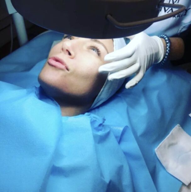 Un traitement effectué par un docteur sur le visage pour lutter contre l´acnée