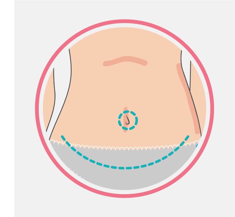 Infographie abdominoplastie