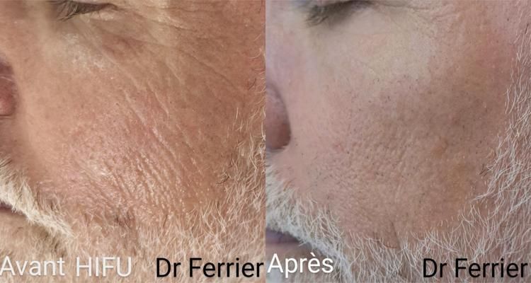Photo avant/apr`s traitement HIFU par le Dr Lionel Ferrier sur Homme barbu