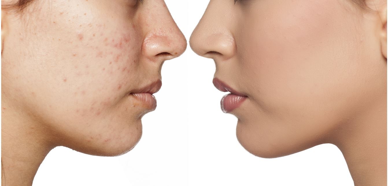 les types d'acné