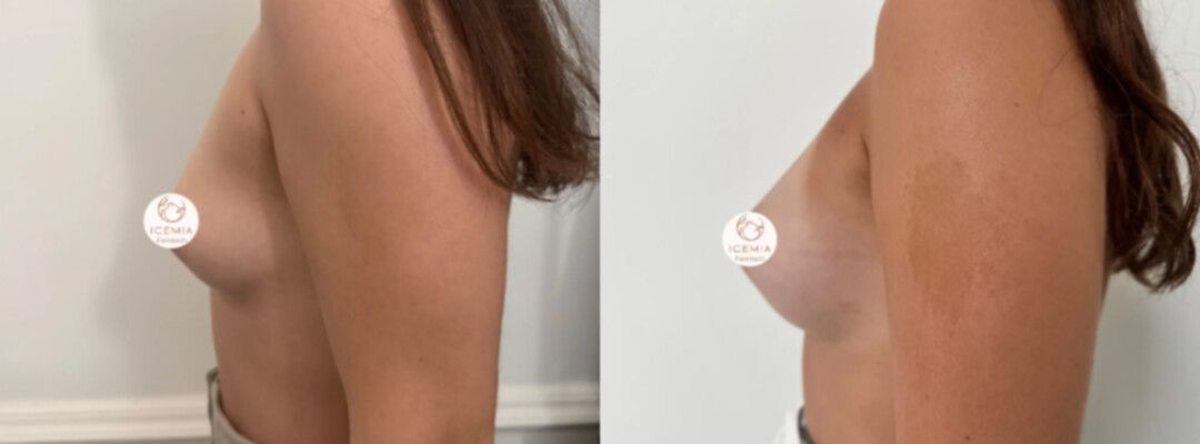avant-après technique Préservé®