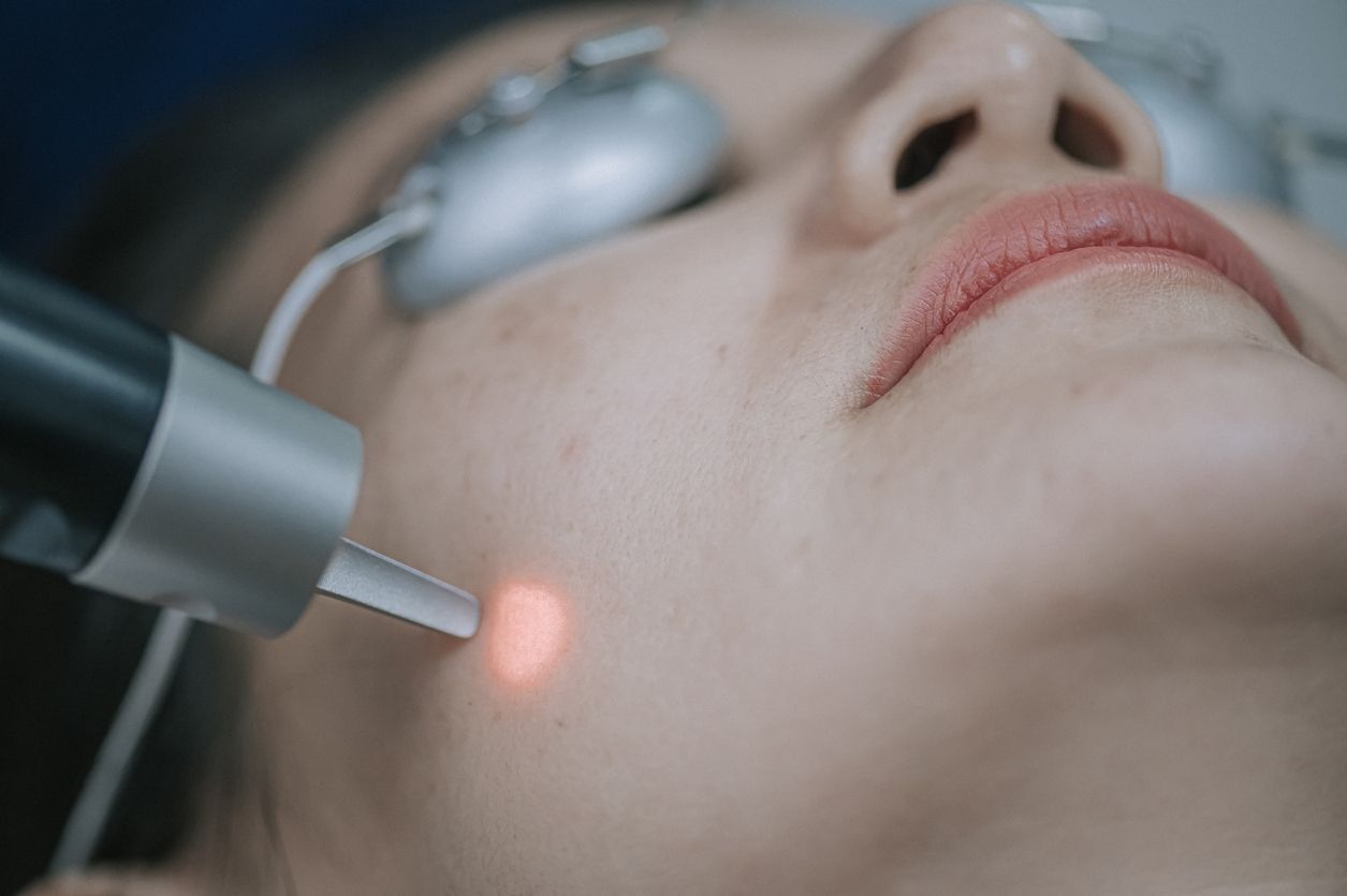 L'épilation laser peut être réalisée sur toutes les parties du corps et du visage
