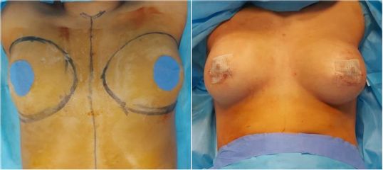Augmentation mammaire - Linea Chirurgie Esthétique