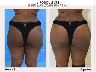 Chirurgie des fesses - Professeur Mourad Zinelabidine