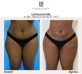 Liposuccion - Professeur Mourad Zinelabidine