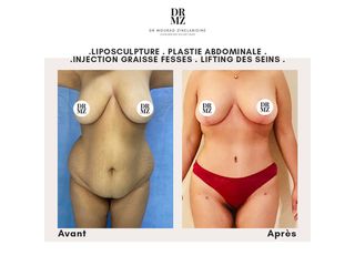 Abdominoplastie - Professeur Mourad Zinelabidine