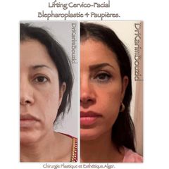 Lifting cervico-facial et blépharoplastie
