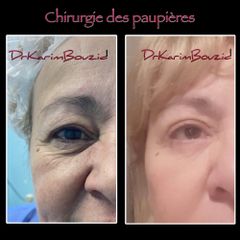 Blépharoplastie avant-après