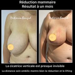 Réduction mammaire avant-après